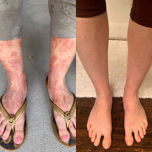 eczemathreated with red light therapy before and after